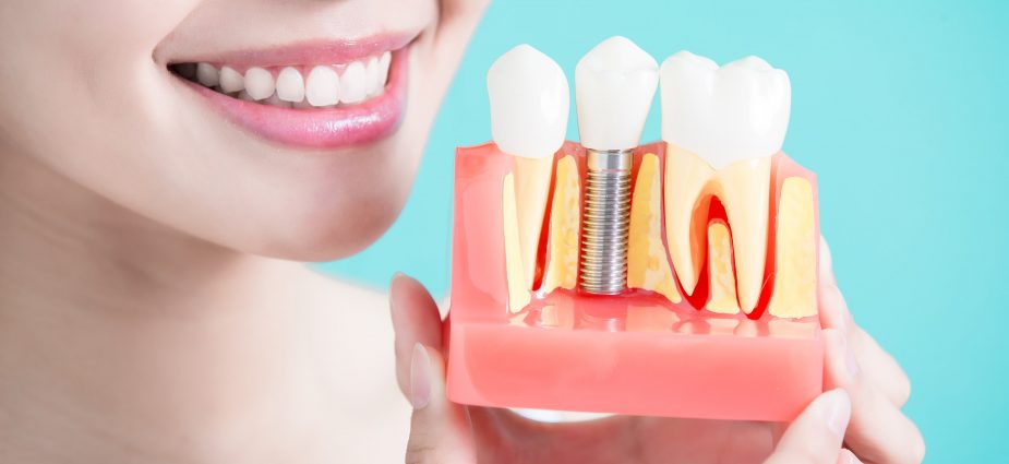 Импланты зубов: показания и противопоказания