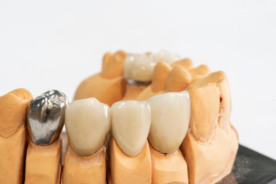 Виды имплантации зубов: плюсы и минусы каждого.