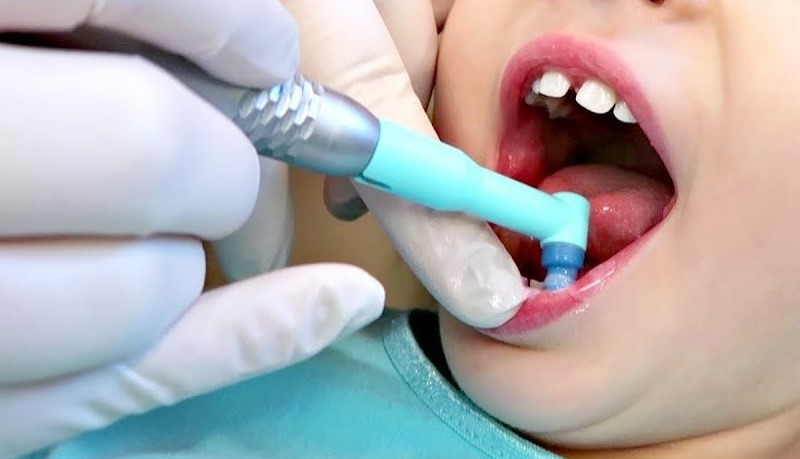 Профессиональная чистка зубов детям в стоматологии.