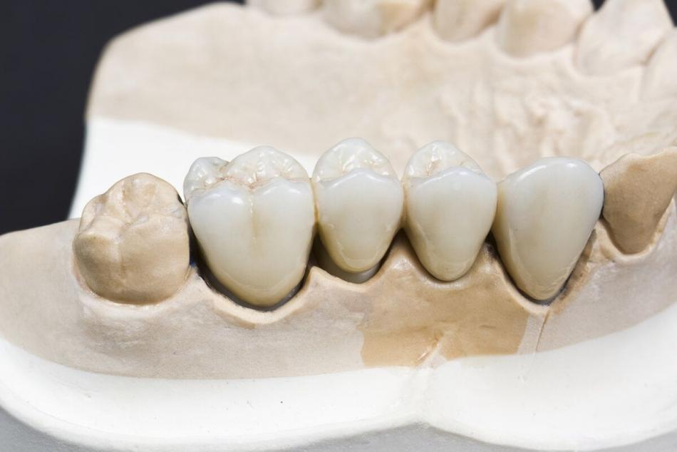 Когда изготавливают мостовидный протез на зубы?