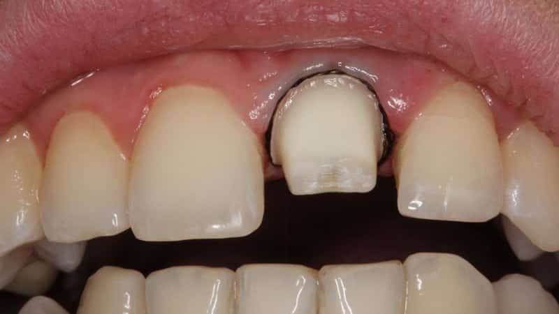 Болит зуб под коронкой - причины воспаления.