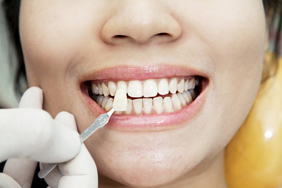 Как устанавливают виниры на зубы прямым методом?