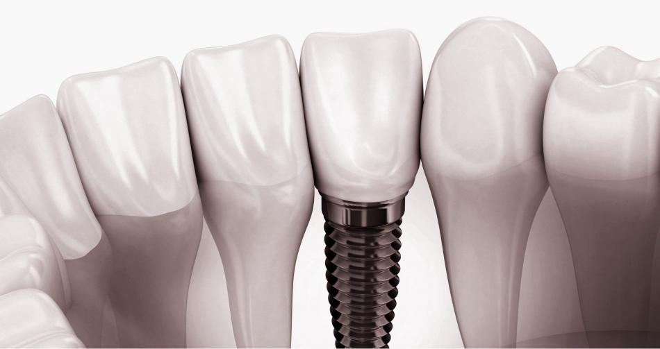 Импланты зубов - какие лучше приживаются?
