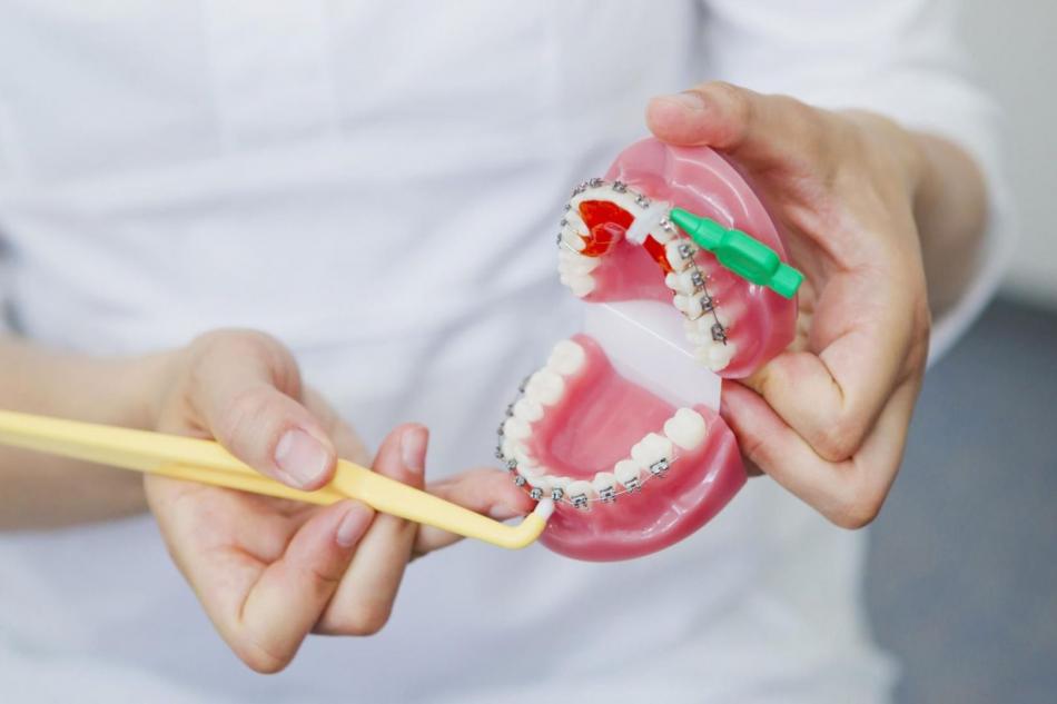 Как чистят нитью и ершиками зубы с брекетами?