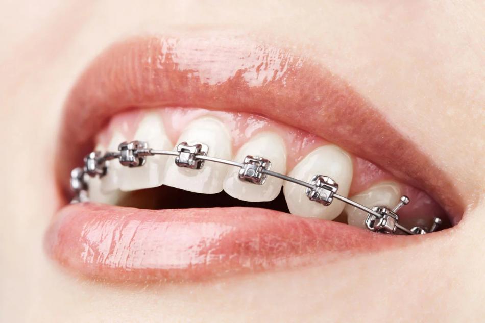 Стоимость самолигирующих брекетов в стоматологии.