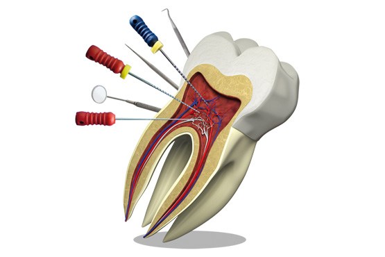 Как восстановить зуб эндодонтическим лечением?