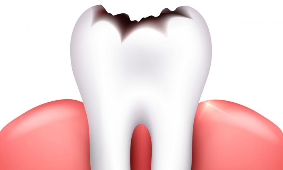 Кариес на зубах - причины и лечение.