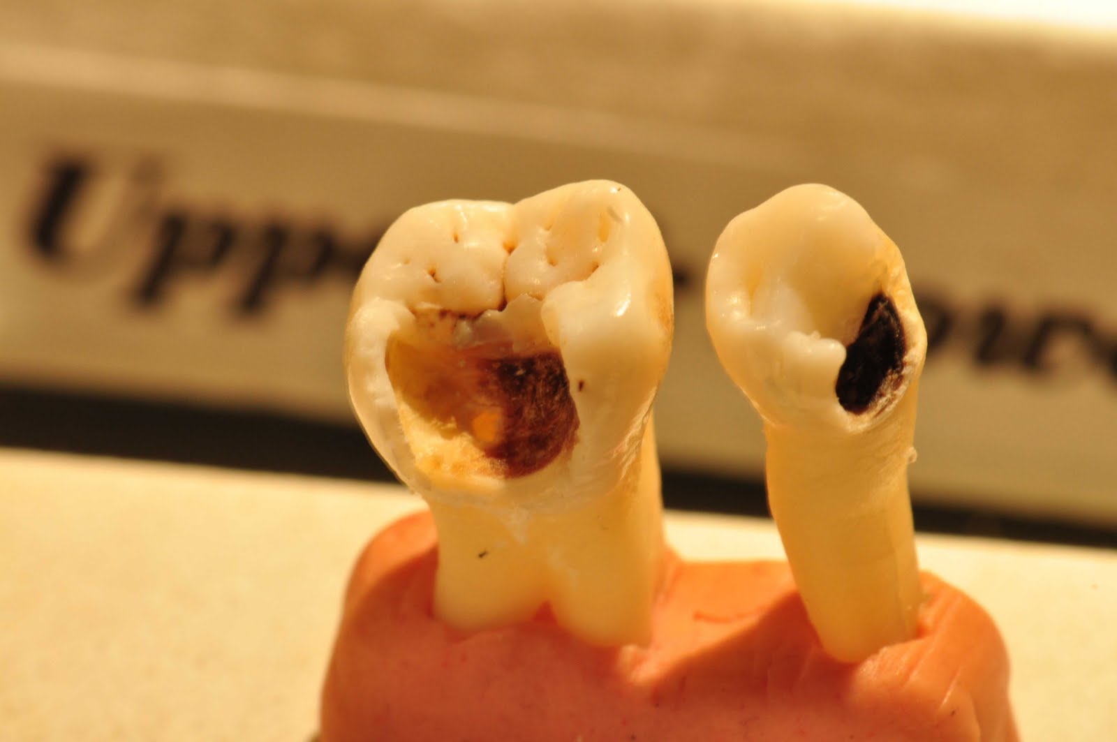 Виды кариеса: какие типы различают в стоматологии