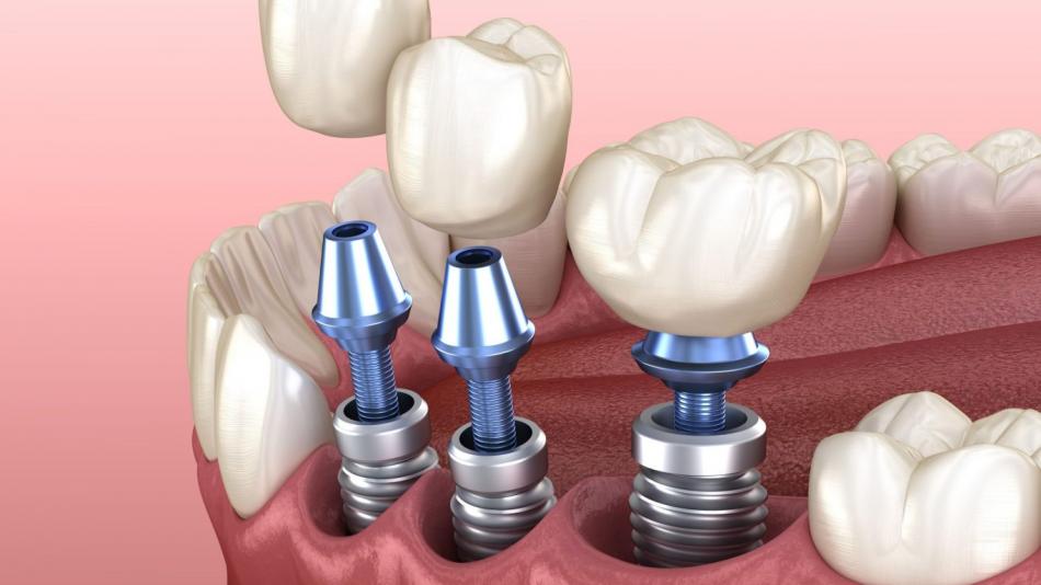 Установка импланта зуба в стоматологии.