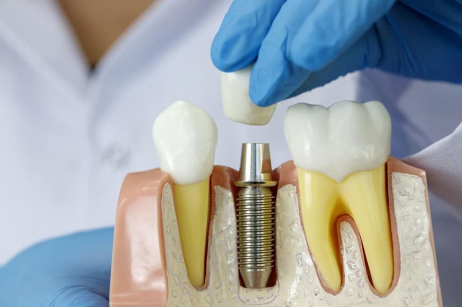 Что влияет на цену имплантации зубов?