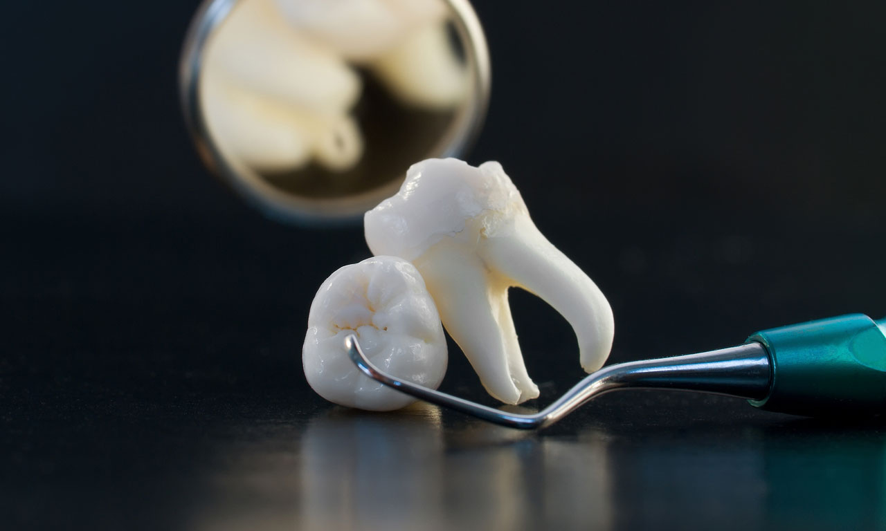 Как ухаживать за раной после удаления зуба?